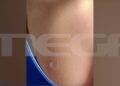 Θεσσαλονίκη: 13χρονη έσβησε τσιγάρο σε 12χρονη για ένα αγόρι – Συγκλονίζει η μητέρα του θύματος